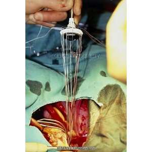  Artificial heart valve surgery Framed Prints